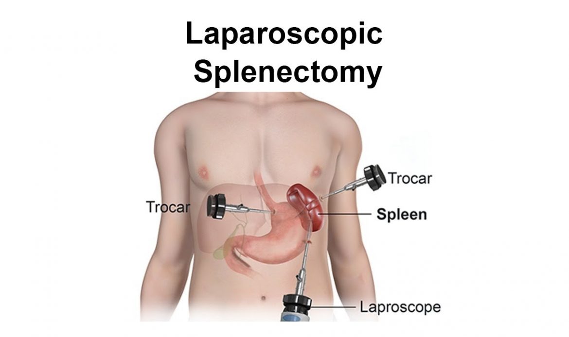 Splenectomy – Surgery for Removal of Spleen in Bengaluru