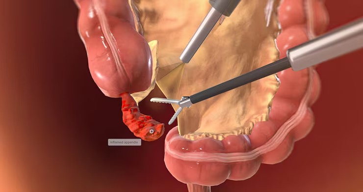 Laparoscopic Appendectomy in Bengaluru