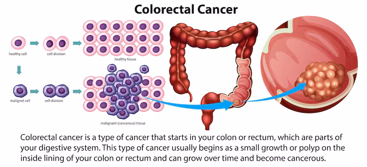 Colon Cancer Treatment – Hemicolectomy Surgery in Bengaluru