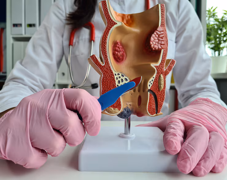 Laser Fistula Treatment in Bengaluru