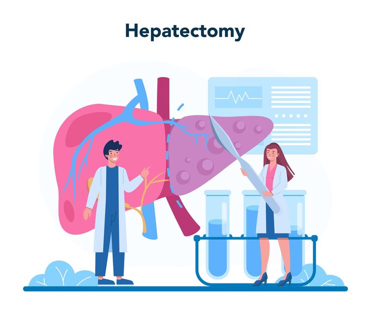 Treatment for Liver Cancer – Hepatectomy in Bengaluru