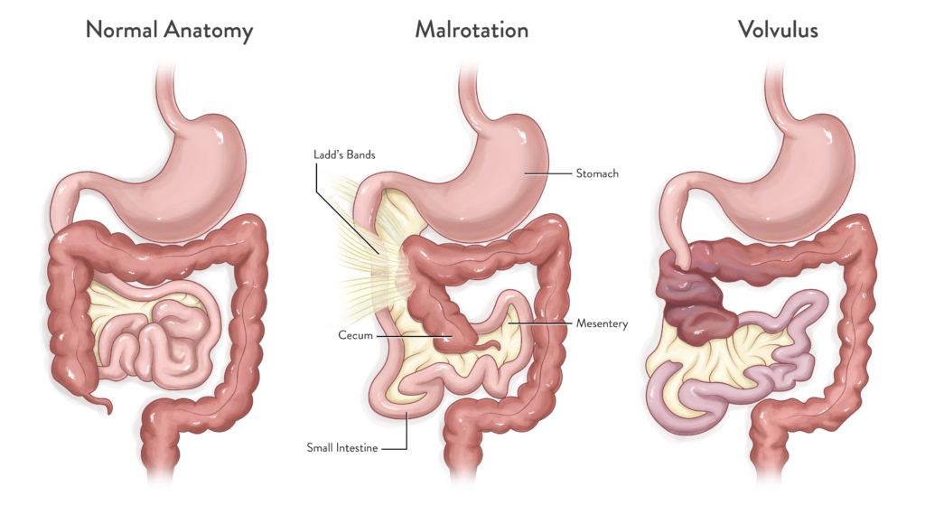 Intestinal Malrotation Treatment – Ladd’s Procedure in Bengaluru