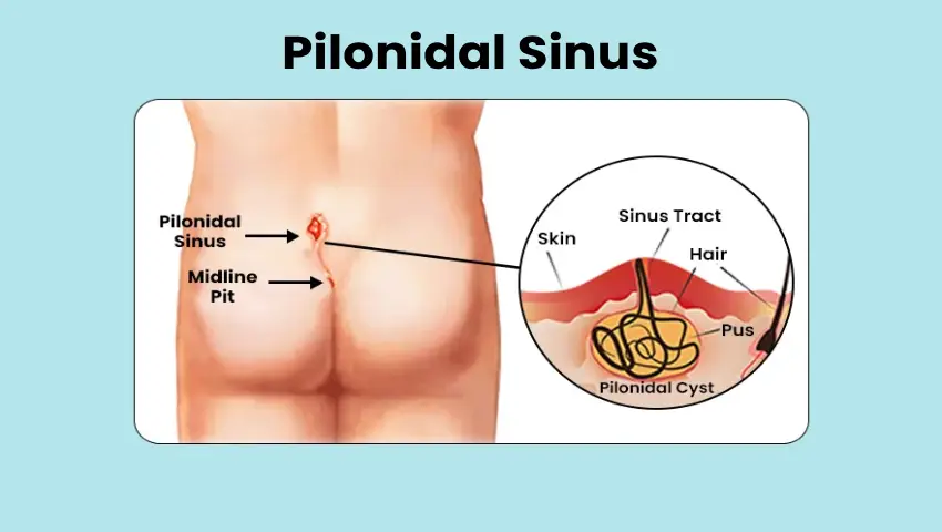 Laser Pilonidal Sinus Treatment in Bengaluru