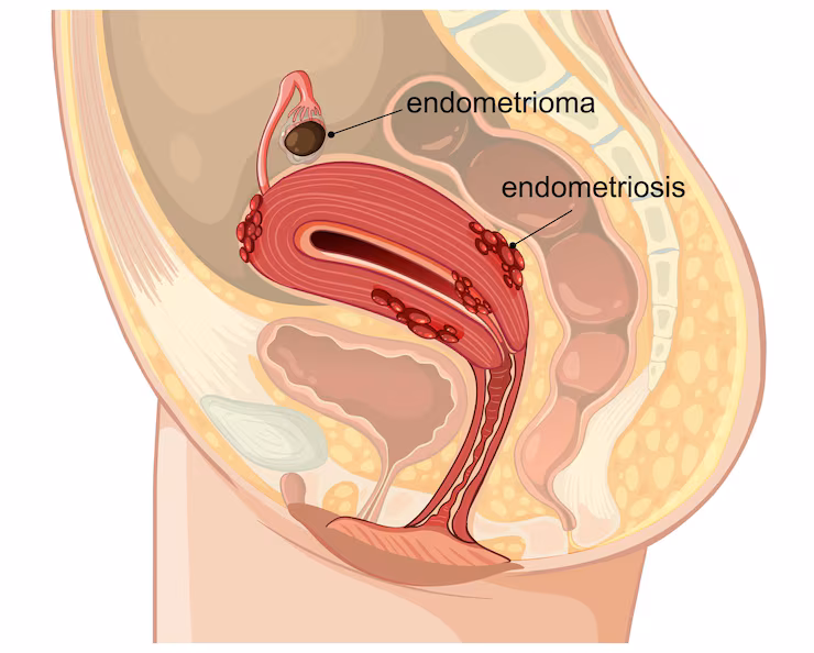 Treatment for Rectal Prolapse – Rectopexy Surgery, Altemeier’s Procedure in Bengaluru